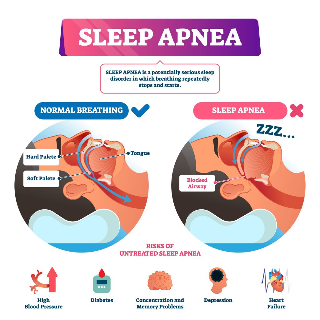 sleep apnea infographic