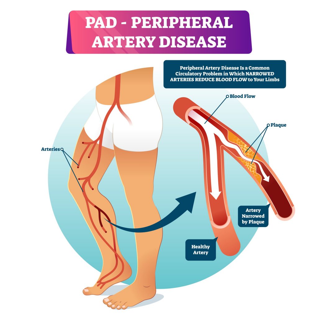 PAD - Peripheral Artery Disease infographic - how it can be an early sign of heart attack or stroke