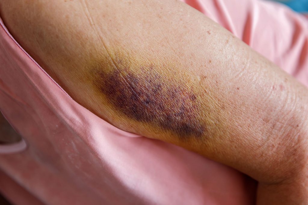 bruise on the arm of a senior person