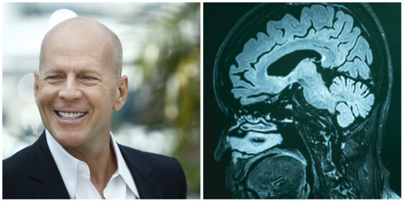 Bruce Willis Diagnosed with Frontotemporal Dementia
