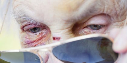 older woman trying to hide physical elder abuse with sunglasses