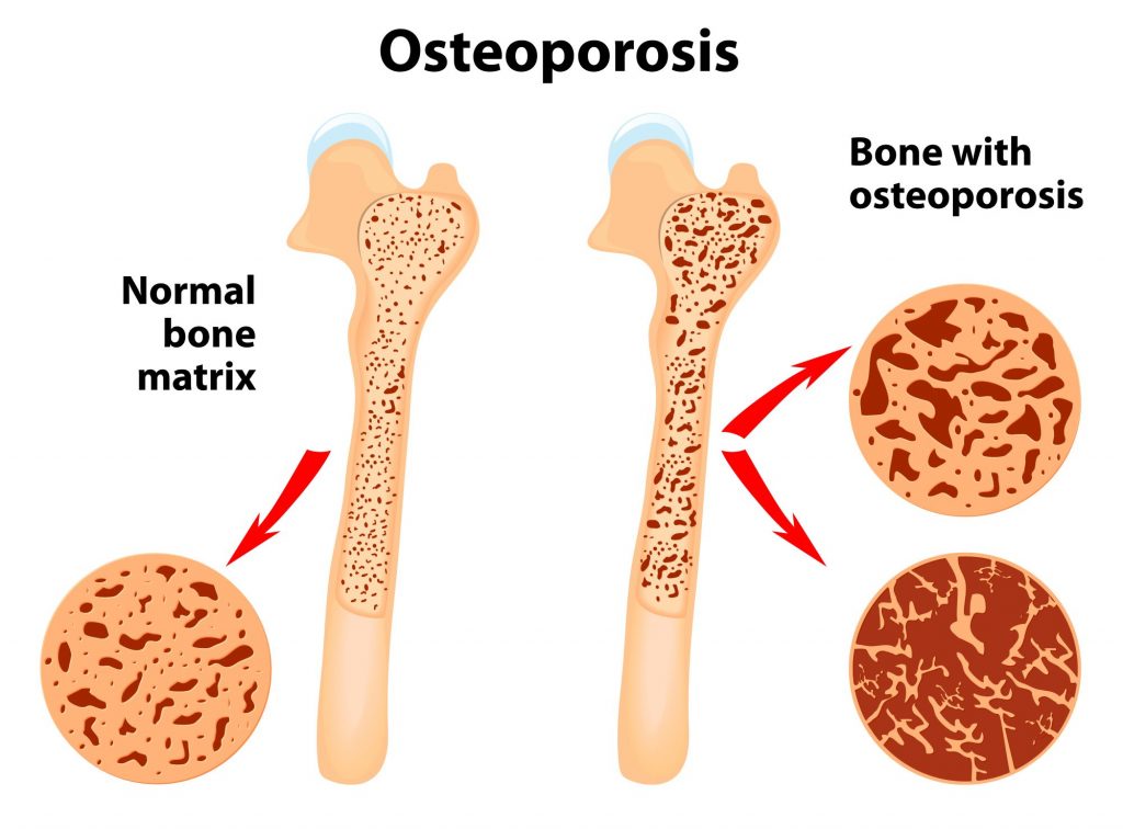 Osteoporosis, health conditions that affect Baby Boomers