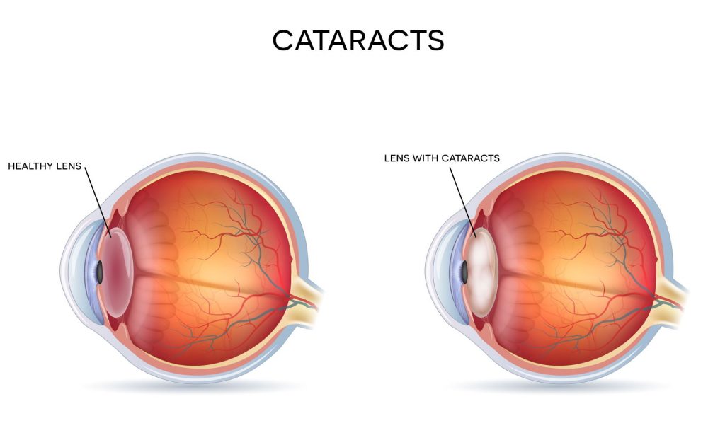 cataracts diagram