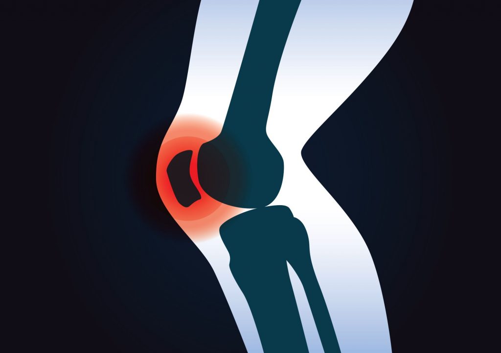 painful knee with arthritis