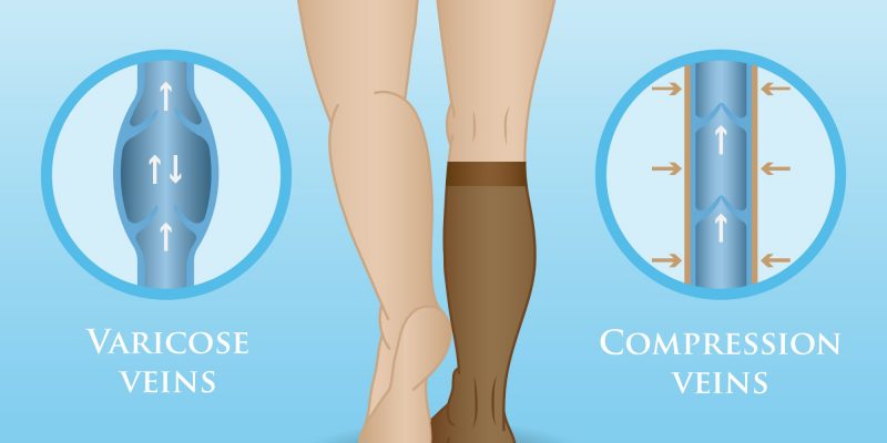compression socks
