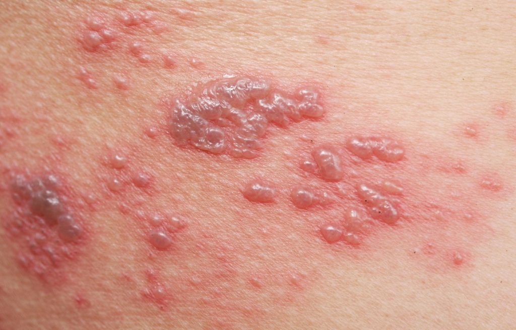 shingles close up photo