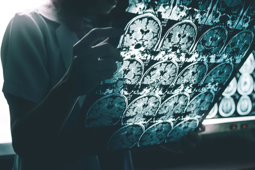 alzheimer's disease on MRI