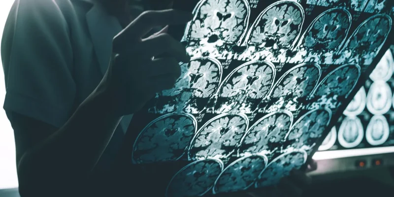 alzheimer's disease on MRI
