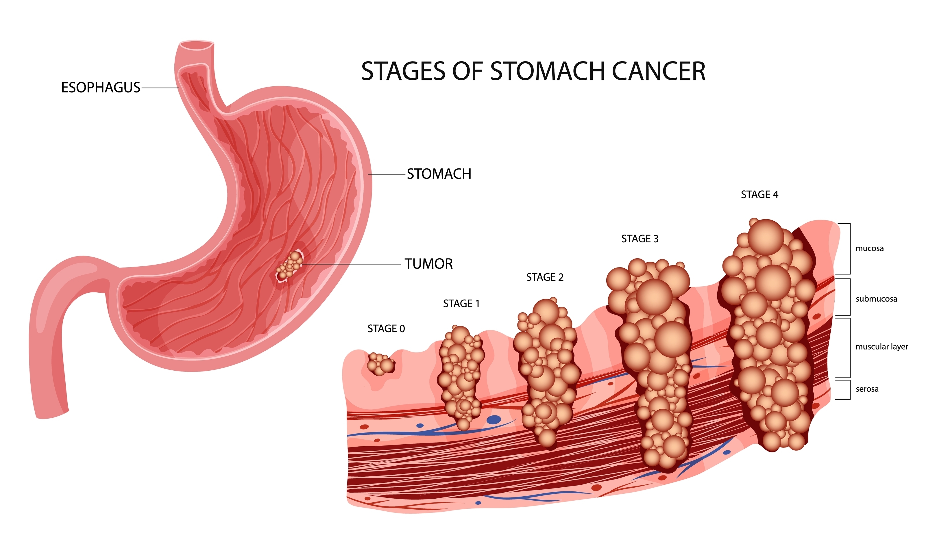 stomach cancer