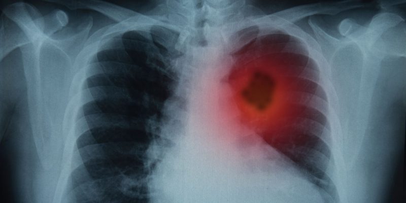 lung cancer on an xray