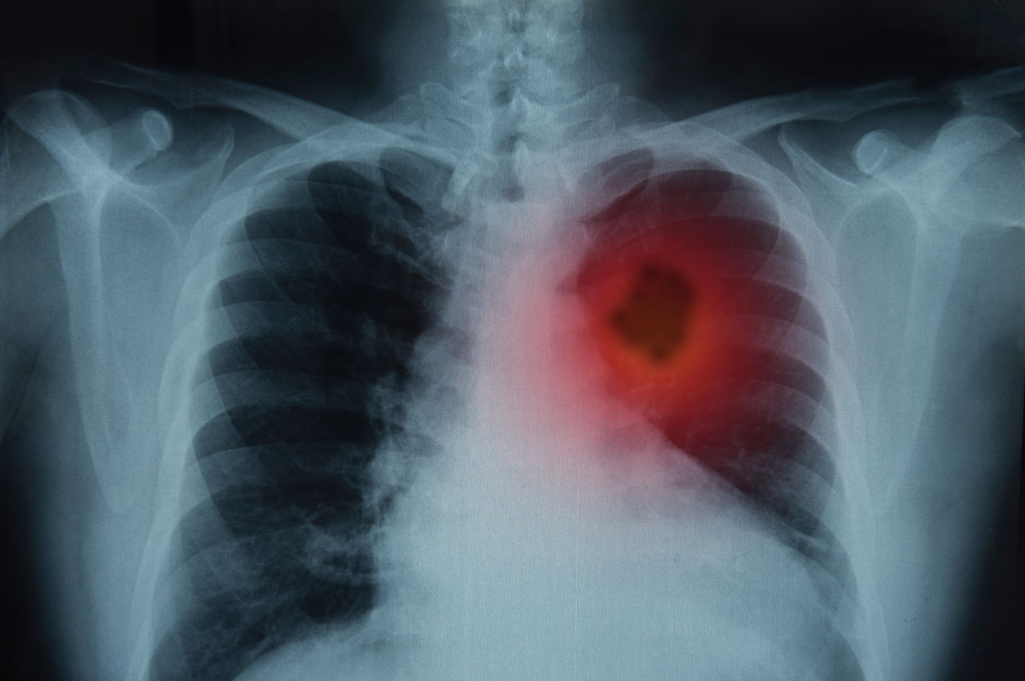 lung cancer on an xray