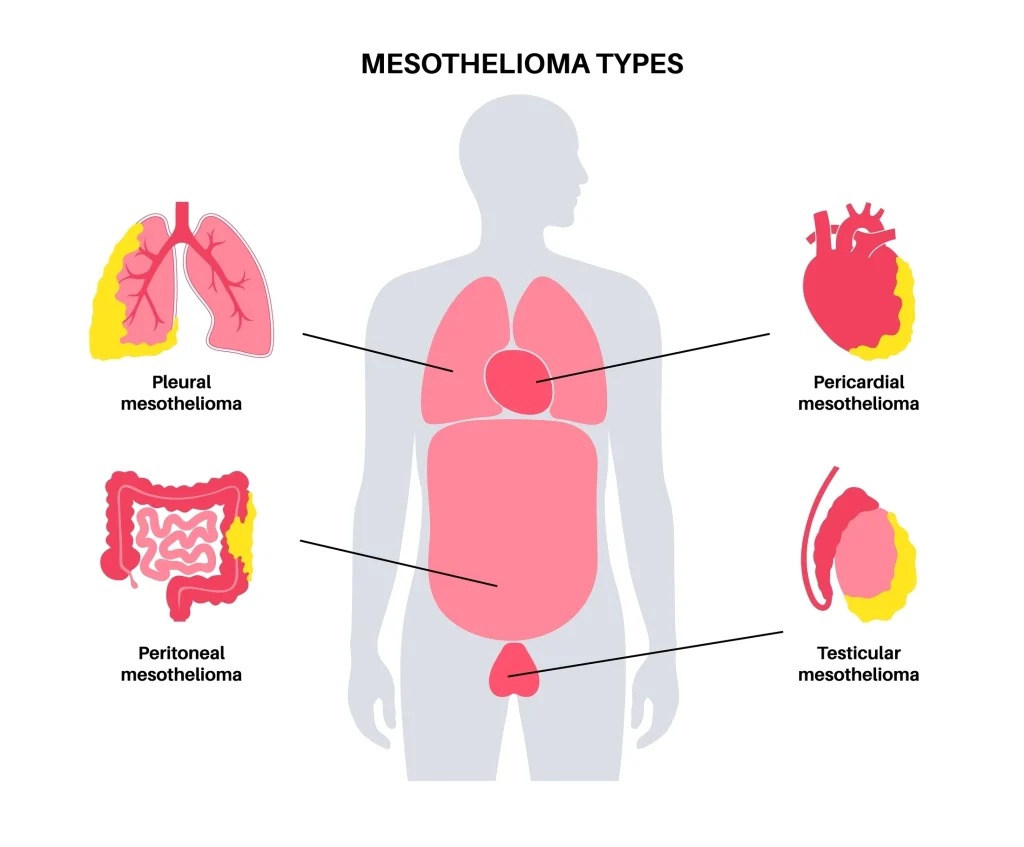  Mesothelioma infographic