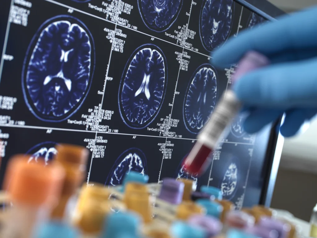 United Kingdom, High Wycombe, Alzheimer's and Dementia Research, Scientist holding a blood sample during a clinical trial with a MRI on screen - stock photo