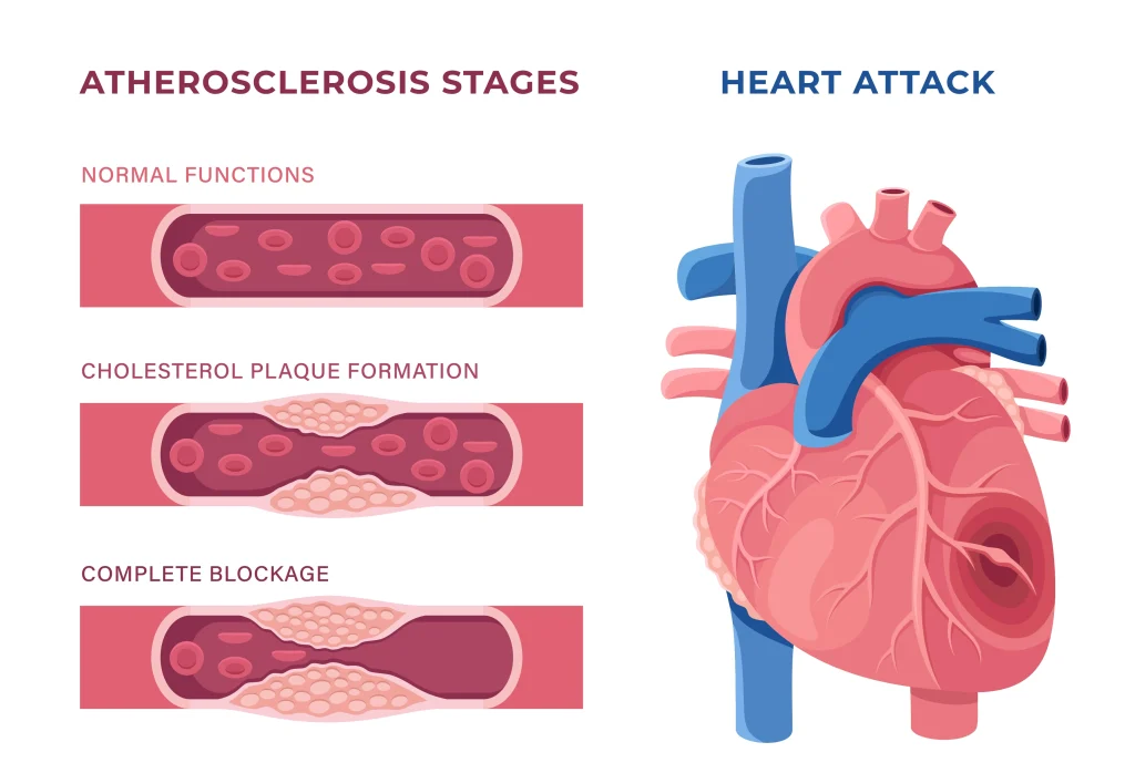 heart attack infographic