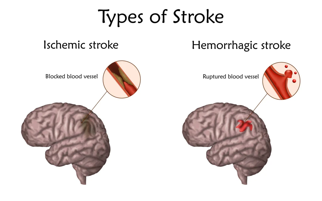 types of stroke infographic